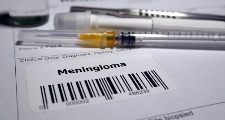 Zdravilo za raka dojke pokazalo učinek pri agresivnih meningiomih